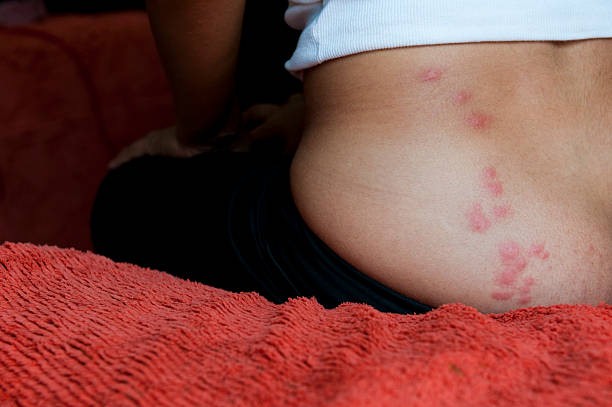 Close-up consequences of a bed bug infestation